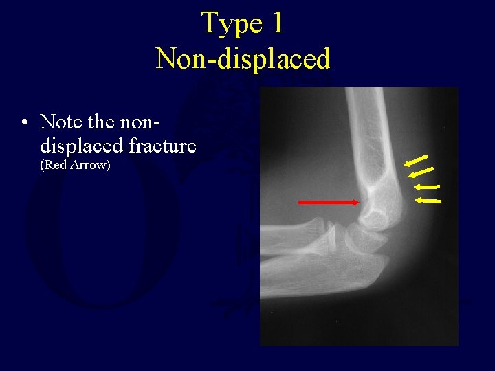 Type 1 Non-displaced • Note the nondisplaced fracture (Red Arrow) 