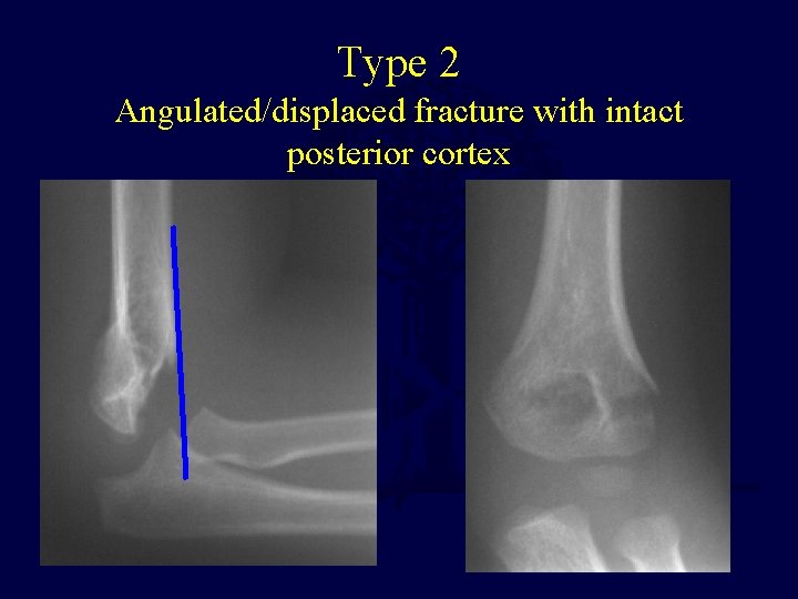 Type 2 Angulated/displaced fracture with intact posterior cortex 