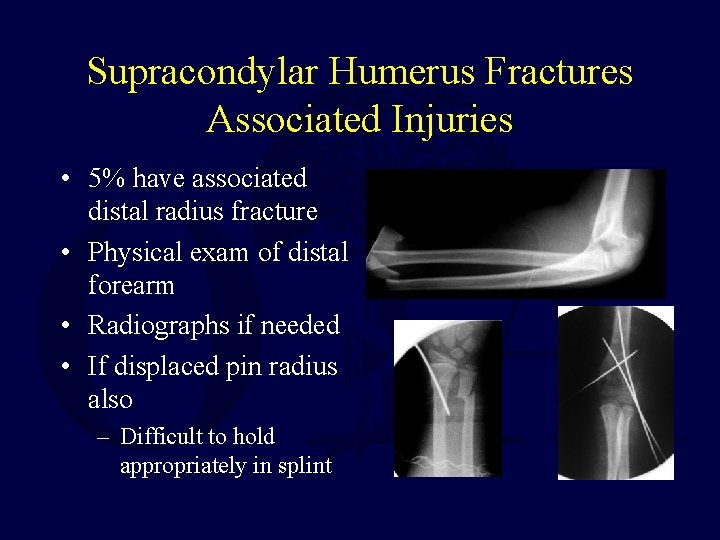 Supracondylar Humerus Fractures Associated Injuries • 5% have associated distal radius fracture • Physical
