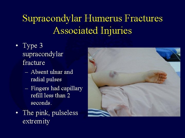 Supracondylar Humerus Fractures Associated Injuries • Type 3 supracondylar fracture – Absent ulnar and