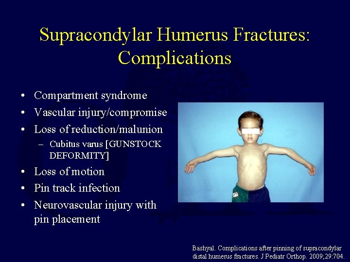 Supracondylar Humerus Fractures: Complications • Compartment syndrome • Vascular injury/compromise • Loss of reduction/malunion
