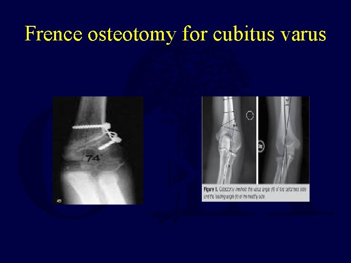 Frence osteotomy for cubitus varus 