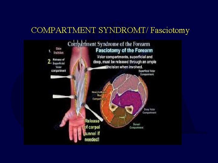 COMPARTMENT SYNDROMT/ Fasciotomy 