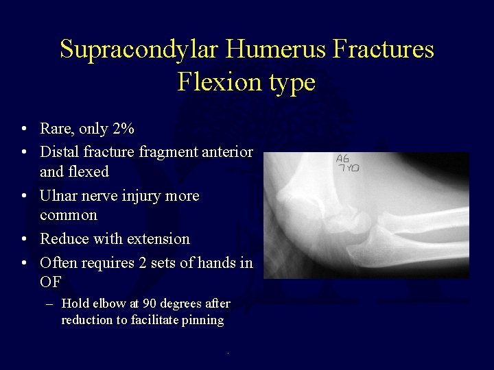 Supracondylar Humerus Fractures Flexion type • Rare, only 2% • Distal fracture fragment anterior