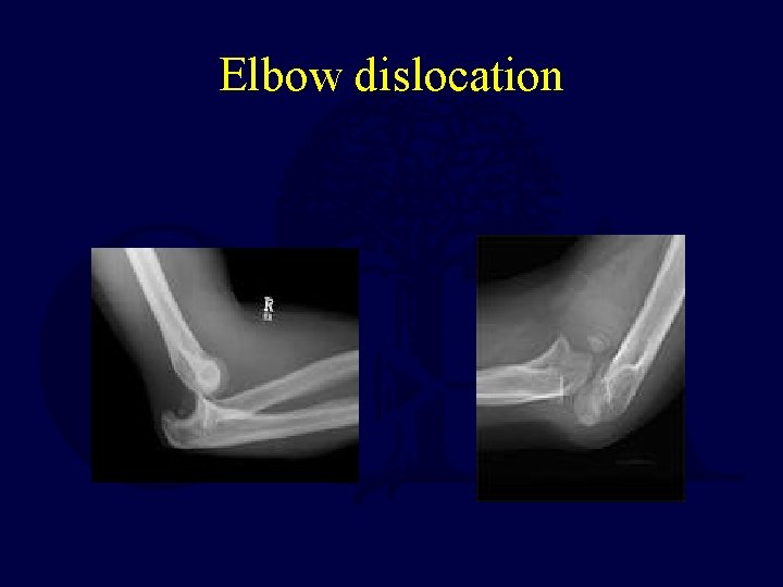 Elbow dislocation 