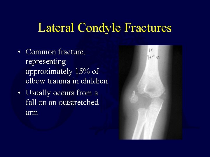 Lateral Condyle Fractures • Common fracture, representing approximately 15% of elbow trauma in children