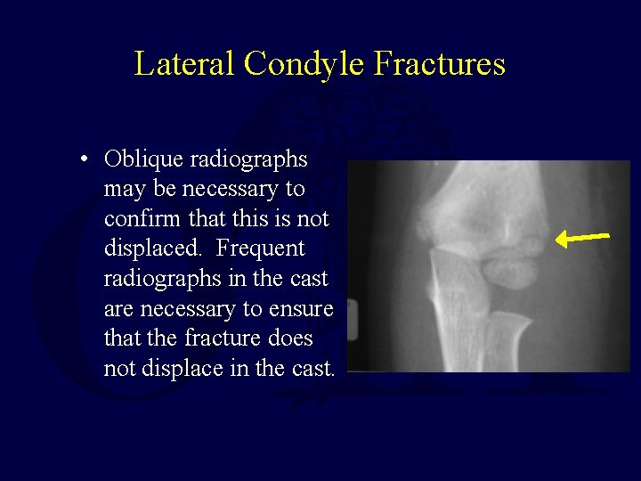 Lateral Condyle Fractures • Oblique radiographs may be necessary to confirm that this is