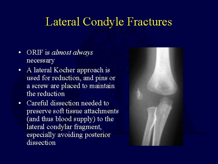 Lateral Condyle Fractures • ORIF is almost always necessary • A lateral Kocher approach
