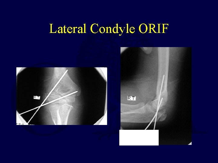 Lateral Condyle ORIF 