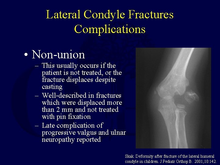 Lateral Condyle Fractures Complications • Non-union – This usually occurs if the patient is