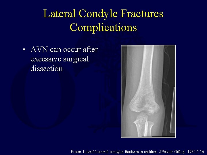 Lateral Condyle Fractures Complications • AVN can occur after excessive surgical dissection Foster. Lateral