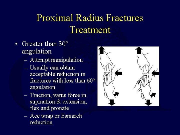 Proximal Radius Fractures Treatment • Greater than 30° angulation – Attempt manipulation – Usually