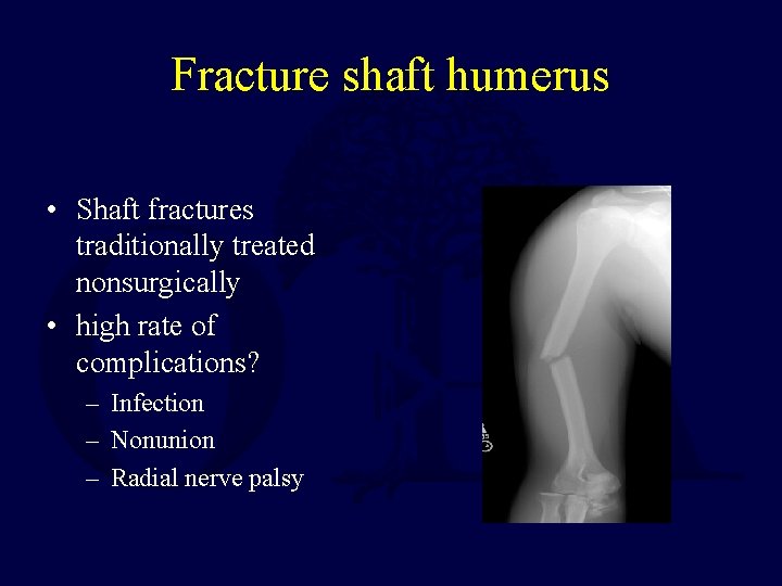 Fracture shaft humerus • Shaft fractures traditionally treated nonsurgically • high rate of complications?