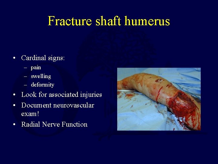 Fracture shaft humerus • Cardinal signs: – pain – swelling – deformity • Look