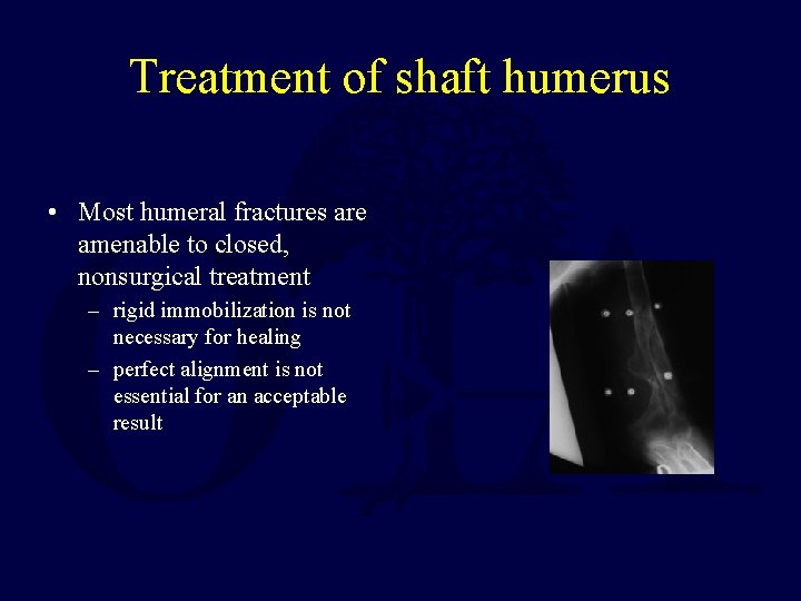 Treatment of shaft humerus • Most humeral fractures are amenable to closed, nonsurgical treatment