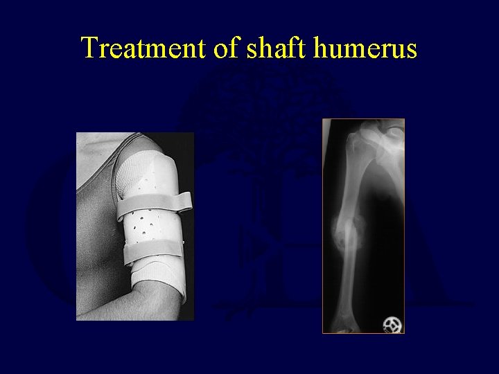 Treatment of shaft humerus 