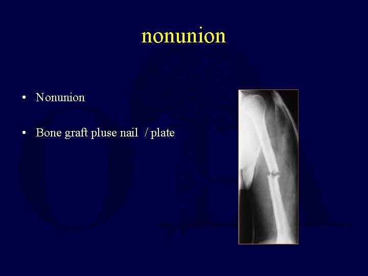 nonunion • Nonunion • Bone graft pluse nail / plate 