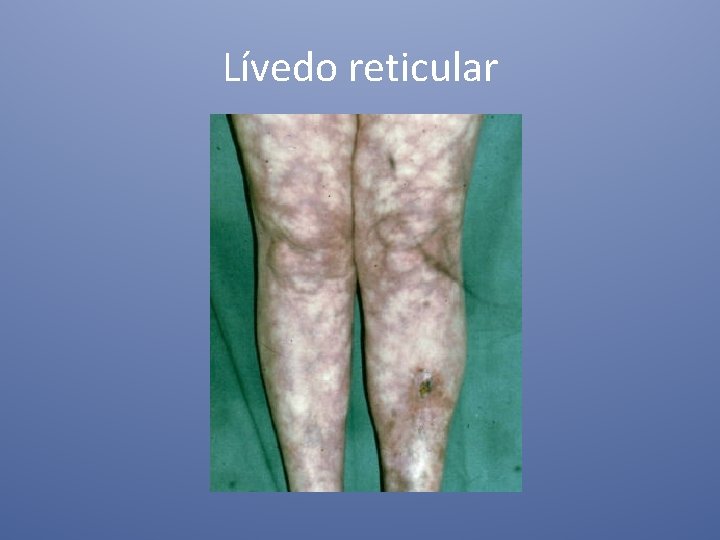 Lívedo reticular 