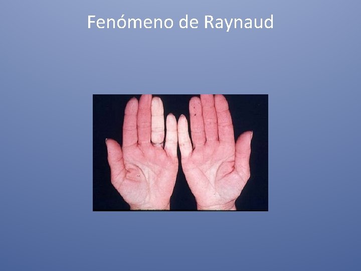 Fenómeno de Raynaud 