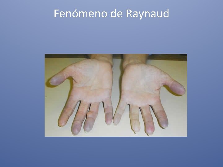 Fenómeno de Raynaud 