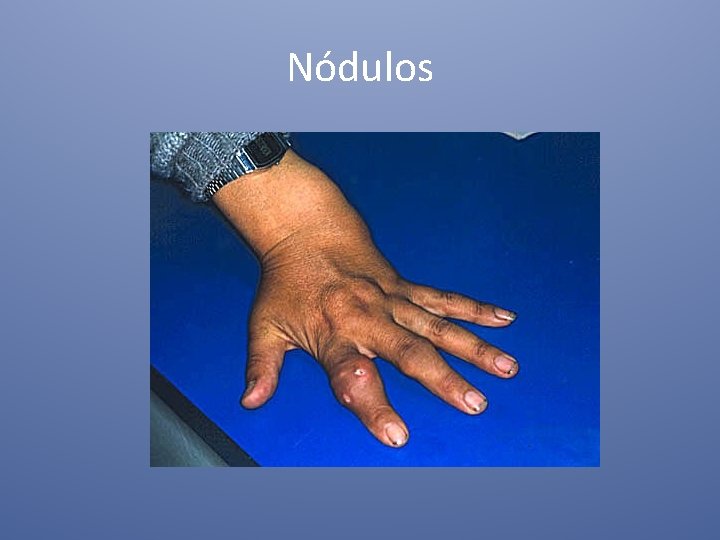 Nódulos 