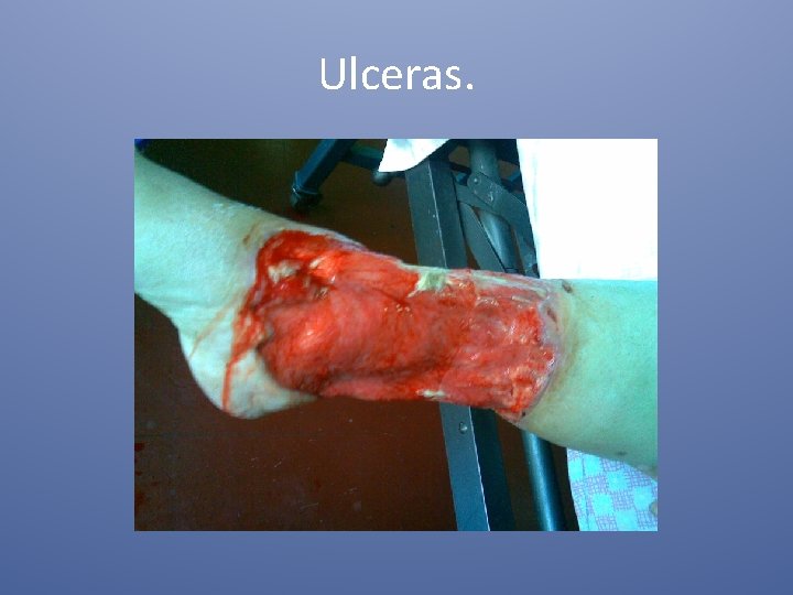 Ulceras. 