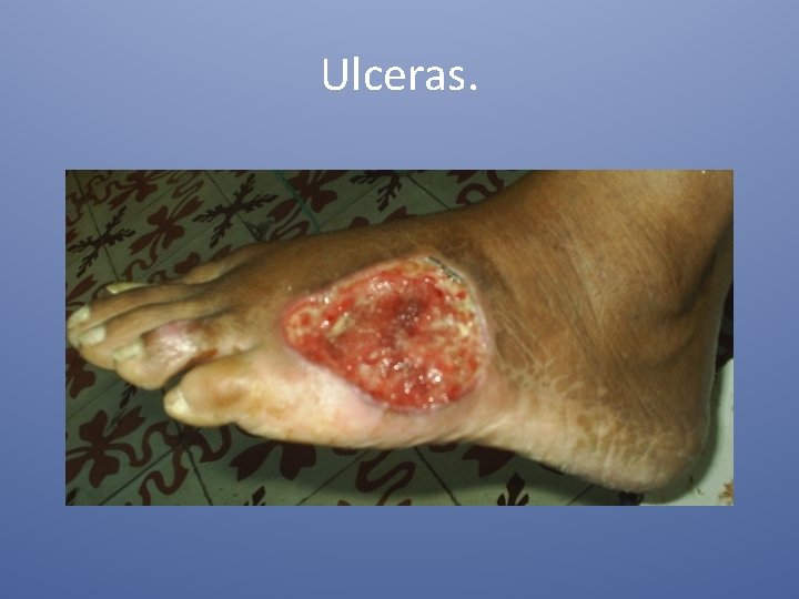 Ulceras. 