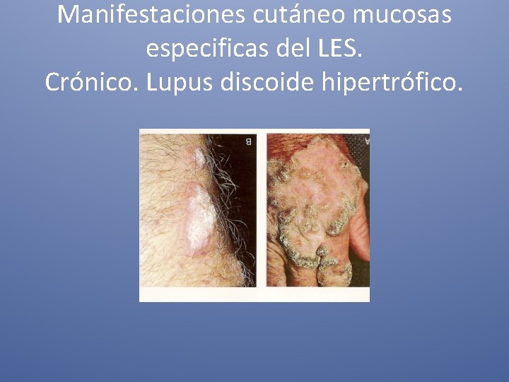 Manifestaciones cutáneo mucosas especificas del LES. Crónico. Lupus discoide hipertrófico. 