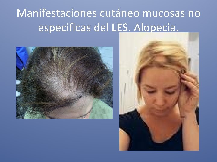 Manifestaciones cutáneo mucosas no especificas del LES. Alopecia. 