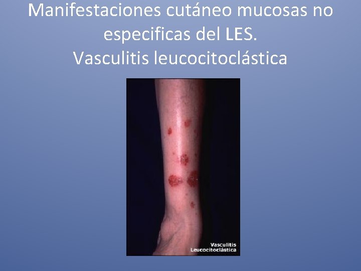 Manifestaciones cutáneo mucosas no especificas del LES. Vasculitis leucocitoclástica 