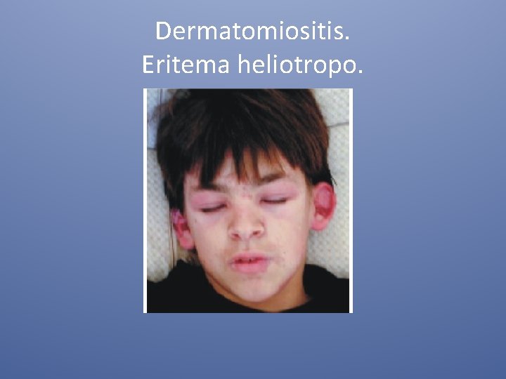 Dermatomiositis. Eritema heliotropo. 