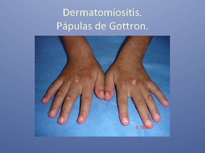 Dermatomiositis. Pápulas de Gottron. 