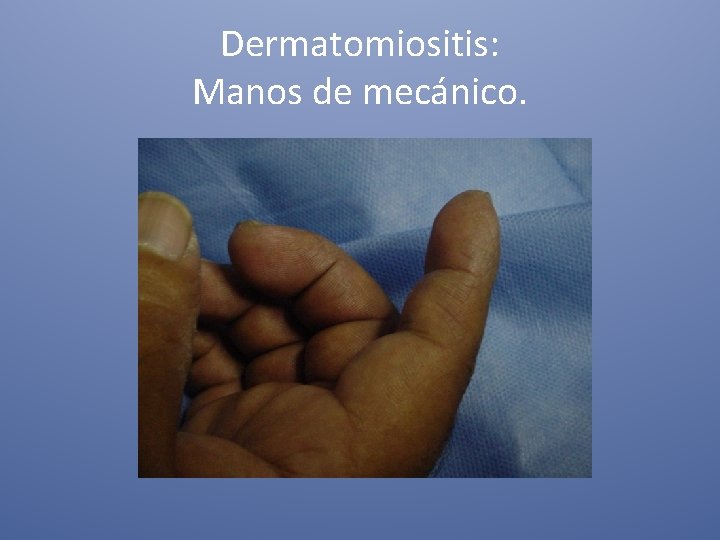 Dermatomiositis: Manos de mecánico. 