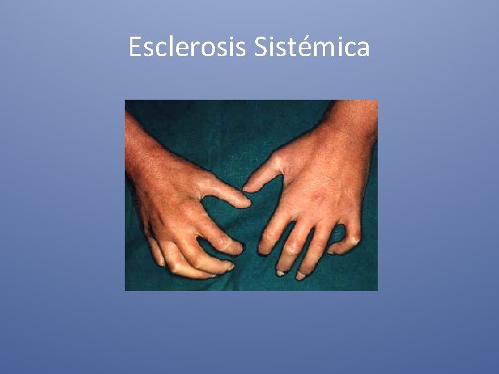 Esclerosis Sistémica 
