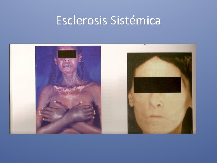 Esclerosis Sistémica 