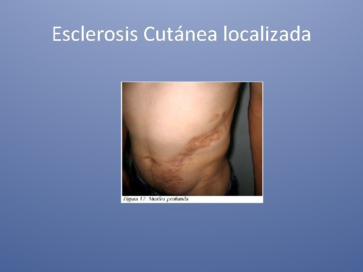 Esclerosis Cutánea localizada 