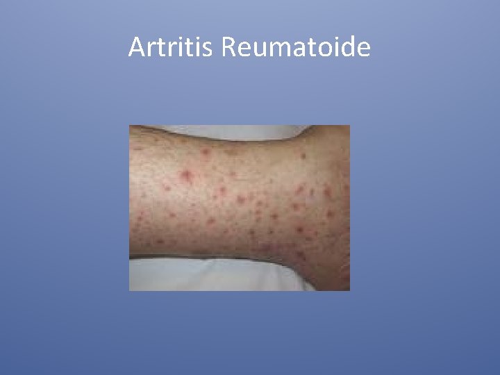 Artritis Reumatoide 