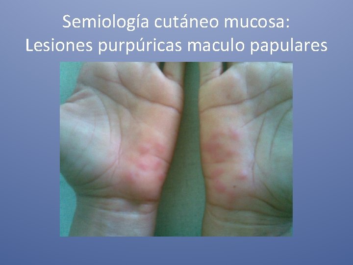 Semiología cutáneo mucosa: Lesiones purpúricas maculo papulares 