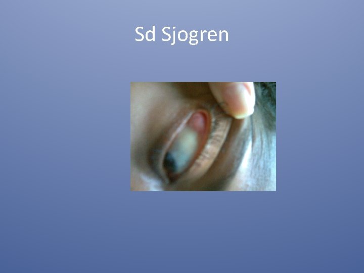 Sd Sjogren 