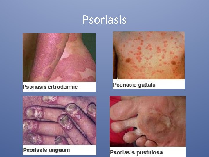 Psoriasis 