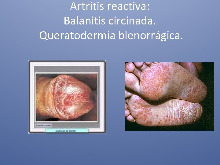 Artritis reactiva: Balanitis circinada. Queratodermia blenorrágica. 