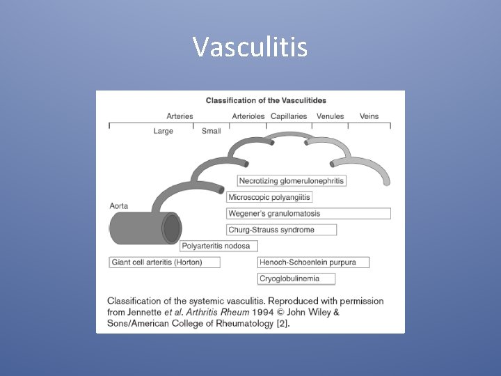 Vasculitis 