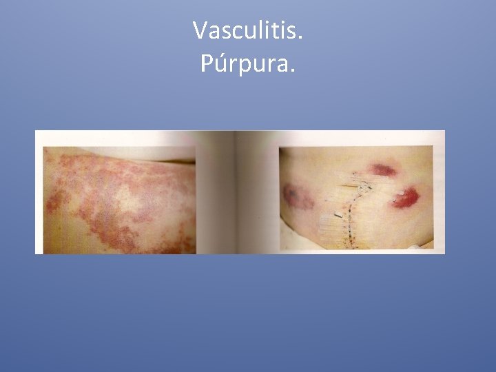 Vasculitis. Púrpura. 