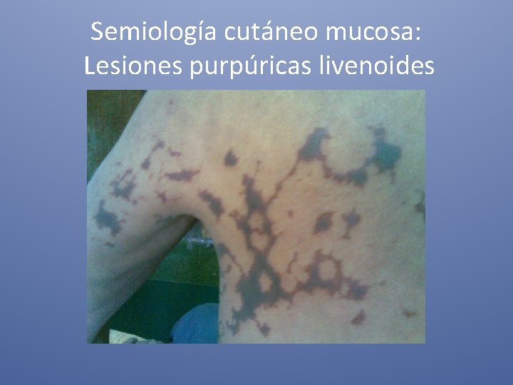 Semiología cutáneo mucosa: Lesiones purpúricas livenoides 