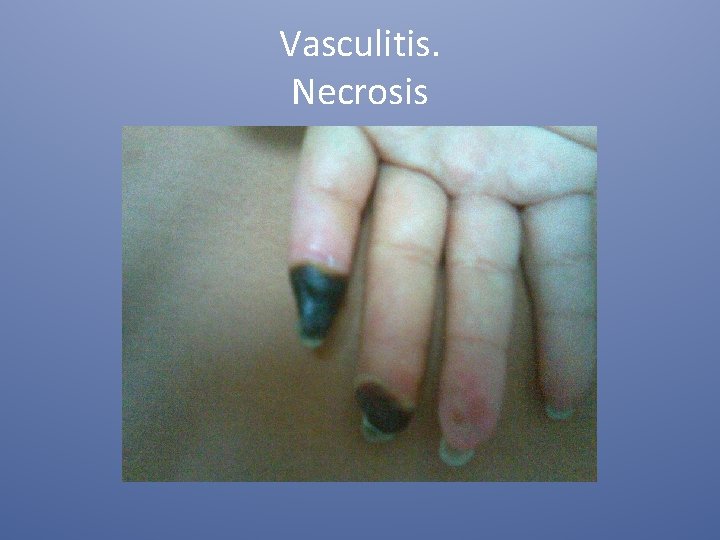 Vasculitis. Necrosis 