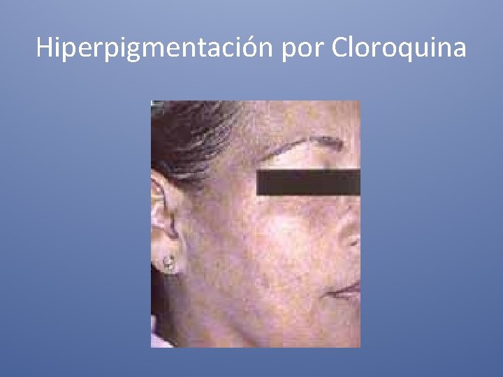 Hiperpigmentación por Cloroquina 