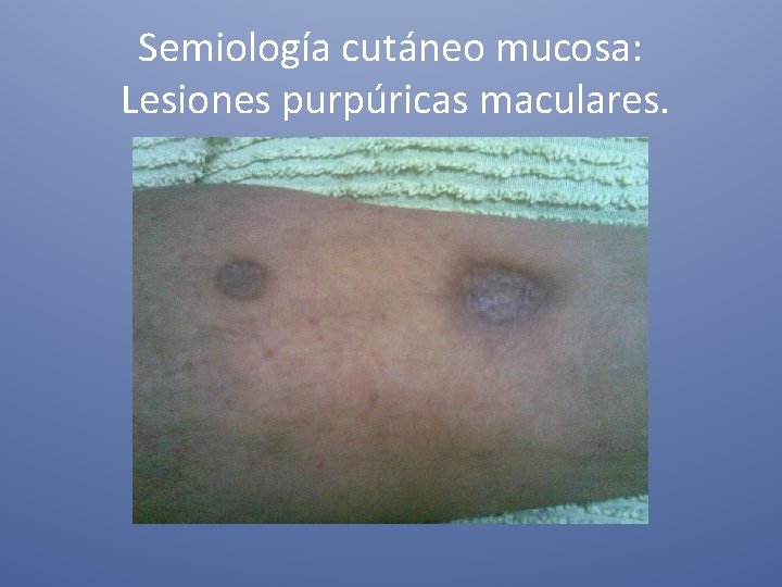 Semiología cutáneo mucosa: Lesiones purpúricas maculares. 