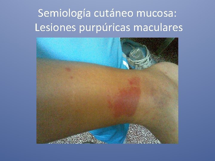 Semiología cutáneo mucosa: Lesiones purpúricas maculares 