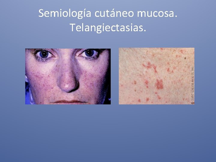 Semiología cutáneo mucosa. Telangiectasias. 