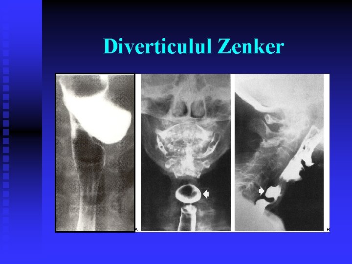 Diverticulul Zenker Diverticulul Zenker